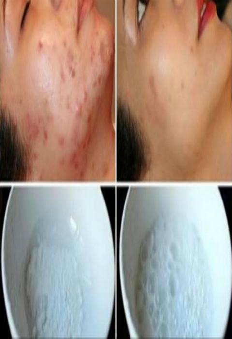 facial acne